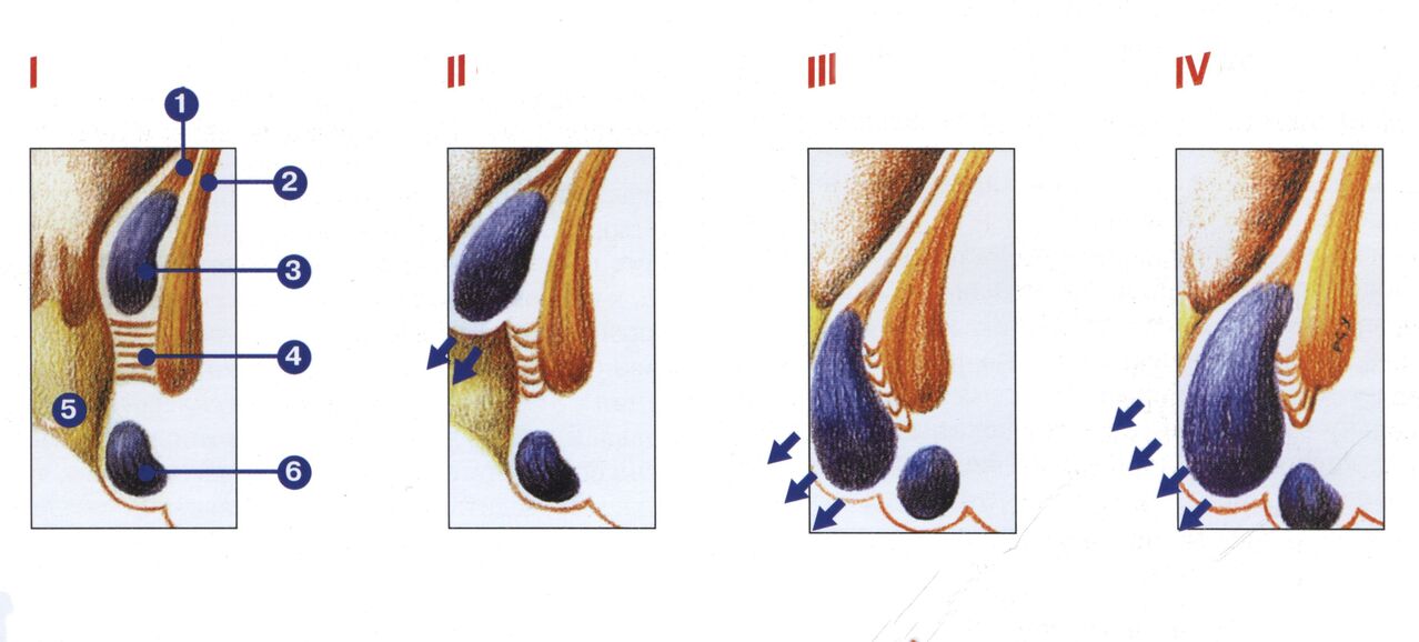 hemorroidide arengu etapid