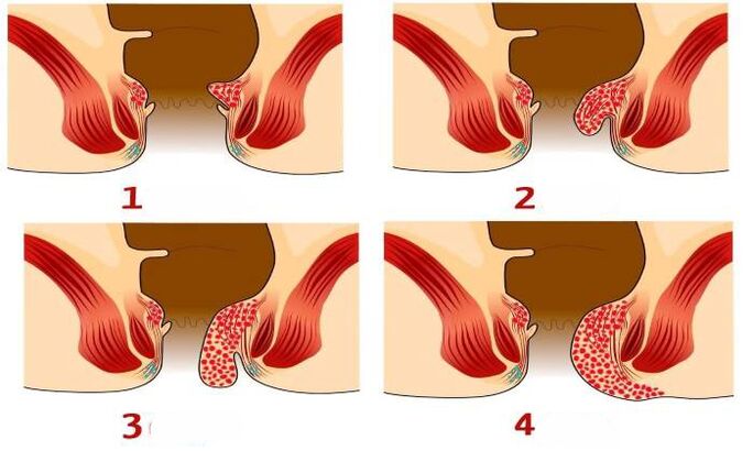 kuidas hemorroidid erinevatel etappidel välja näevad